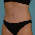Abdominoplasty Before & After Patient #143