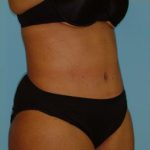 Abdominoplasty Before & After Patient #150