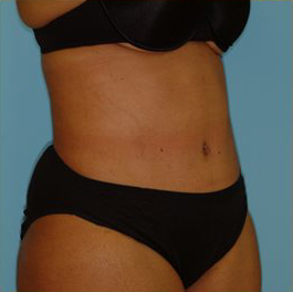 Abdominoplasty Before & After Patient #150