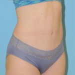 Abdominoplasty Before & After Patient #164