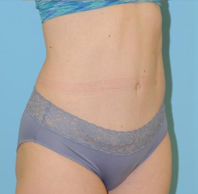 Abdominoplasty Before & After Patient #164