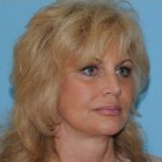 Facelift Before & After Patient #171