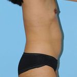 Abdominoplasty Before & After Patient #66