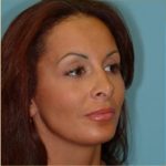 Blepharoplasty Before & After Patient #178