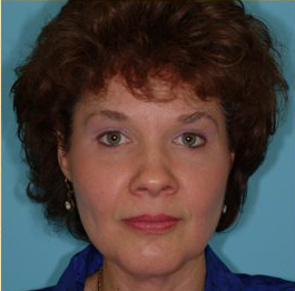 Blepharoplasty Before & After Patient #185