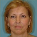 Blepharoplasty Before & After Patient #192