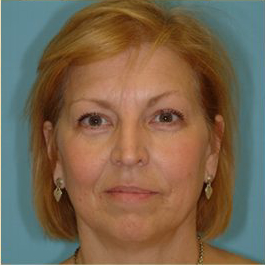 Blepharoplasty Before & After Patient #192