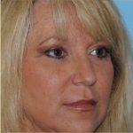 Blepharoplasty Before & After Patient #199