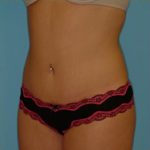 Abdominoplasty Before & After Patient #80