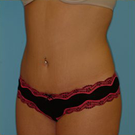 Abdominoplasty Before & After Patient #80
