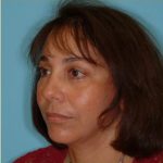 Facelift Before & After Patient #206