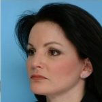 Blepharoplasty Before & After Patient #2770