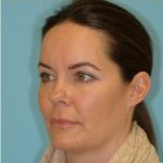 Blepharoplasty Before & After Patient #221