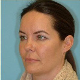 Blepharoplasty Before & After Patient #221