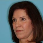 Facelift Before & After Patient #235