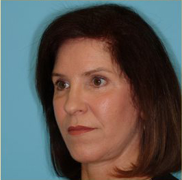 Facelift Before & After Patient #235