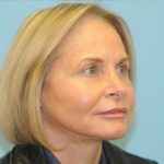 Facelift Before & After Patient #242