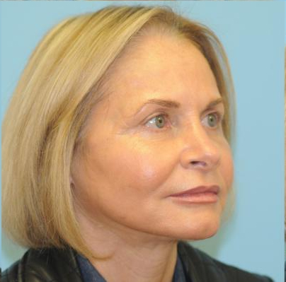 Facelift Before & After Patient #242