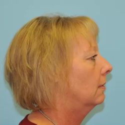 Facelift Before & After Patient #256