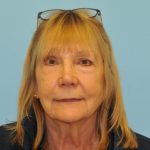 Facelift Before & After Patient #263
