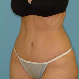 Abdominoplasty Before & After Patient #87