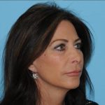 Facelift Before & After Patient #277