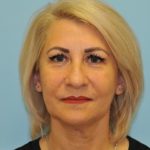 Facelift Before & After Patient #284