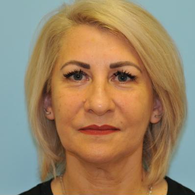 Facelift Before & After Patient #284