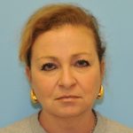 Facelift Before & After Patient #291