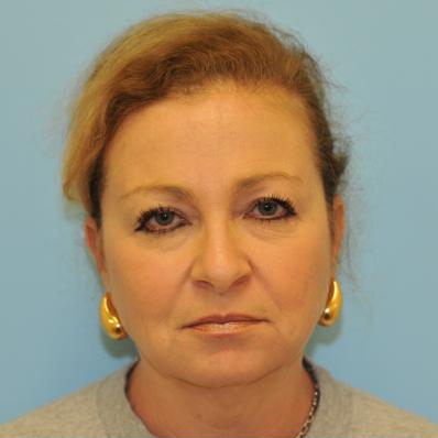 Facelift Before & After Patient #291
