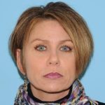 Facelift Before & After Patient #298