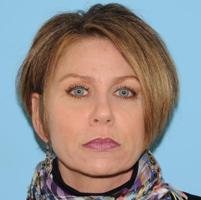 Facelift Before & After Patient #298