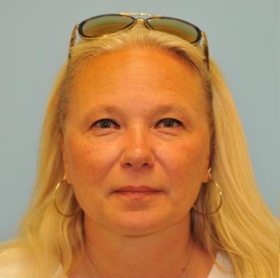 Patient #305 Blepharoplasty Before and After Photos Manhattan, NY