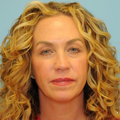 Blepharoplasty Before & After Patient #312