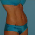 Abdominoplasty Before & After Patient #94
