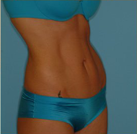 Abdominoplasty Before & After Patient #94
