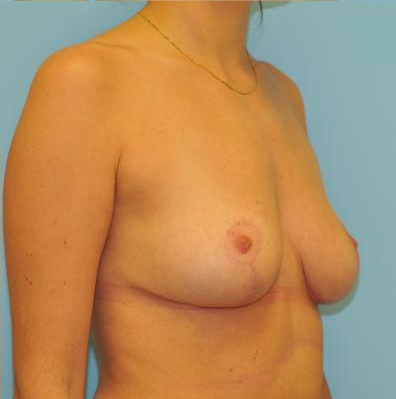 Breast Reduction Before & After Patient #368