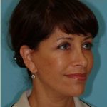 Facelift Before & After Patient #396