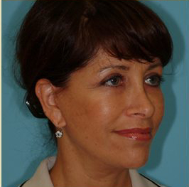 Facelift Before & After Patient #396