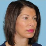 Facelift Before & After Patient #410