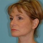 Facelift Before & After Patient #417
