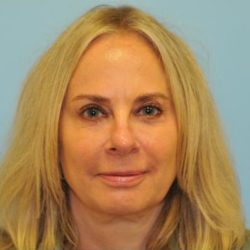 Facelift Before & After Patient #445