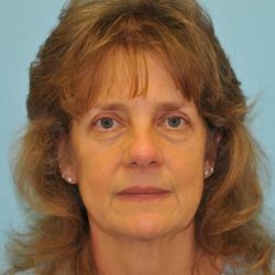 Facelift Before & After Patient #452