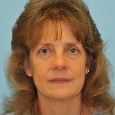 Facelift Before & After Patient #452