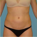 Liposuction Before & After Patient #473
