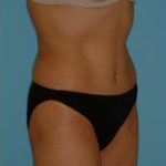 Abdominoplasty Before & After Patient #108