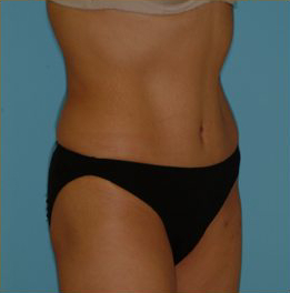 Abdominoplasty Before & After Patient #108