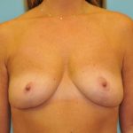 Explanation with Mastopexy Before & After Patient #506