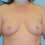 Explanation with Mastopexy Before & After Patient #520