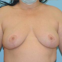 Explanation with Mastopexy Before & After Patient #520